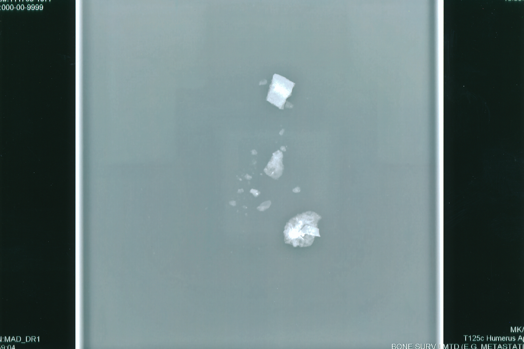 exhibit-431-xray-bone-fragments